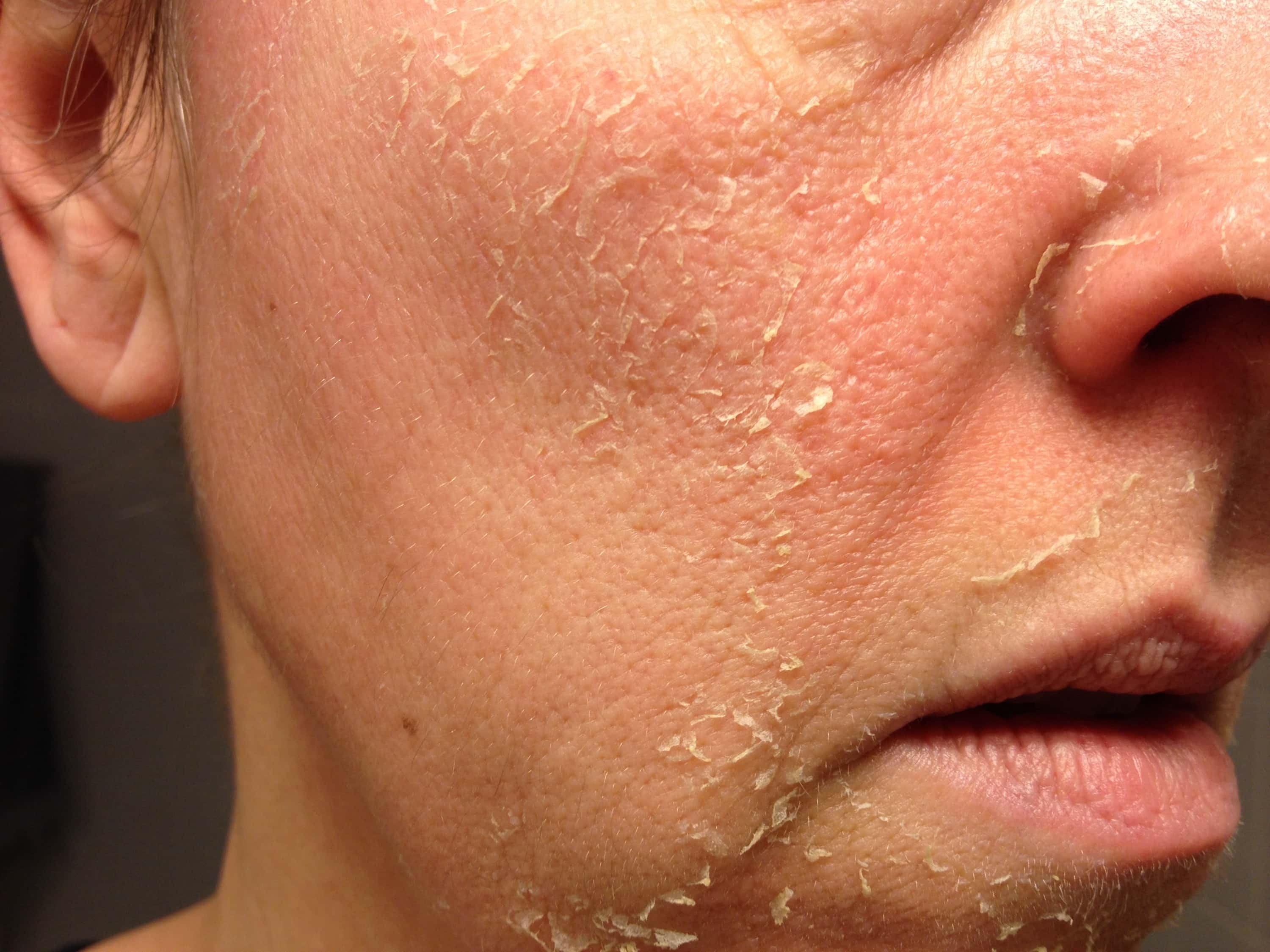 Knuppel schilder Grootste TCA Peeling intensieve behandeling voor huidverbetering