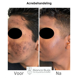 Acnebehandeling donkere huid voor en na foto