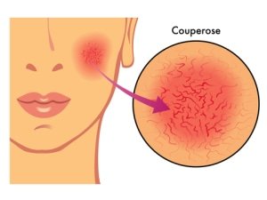 Couperose roodheid in gezicht verwijderen