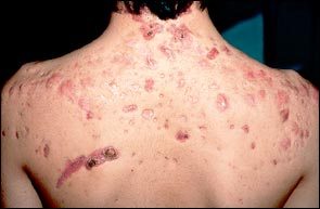 Dermatillomanie, Skin Picking dwangmatig krabben pulken aan huid