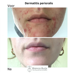 Dermatitis Perioralis, clownseczeem voor en na foto