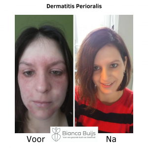 Dermatitis perioralis voor en na foto