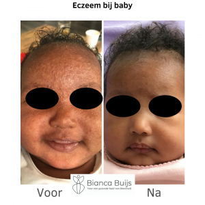 Eczeem bij baby met een donkere huid voor en na foto