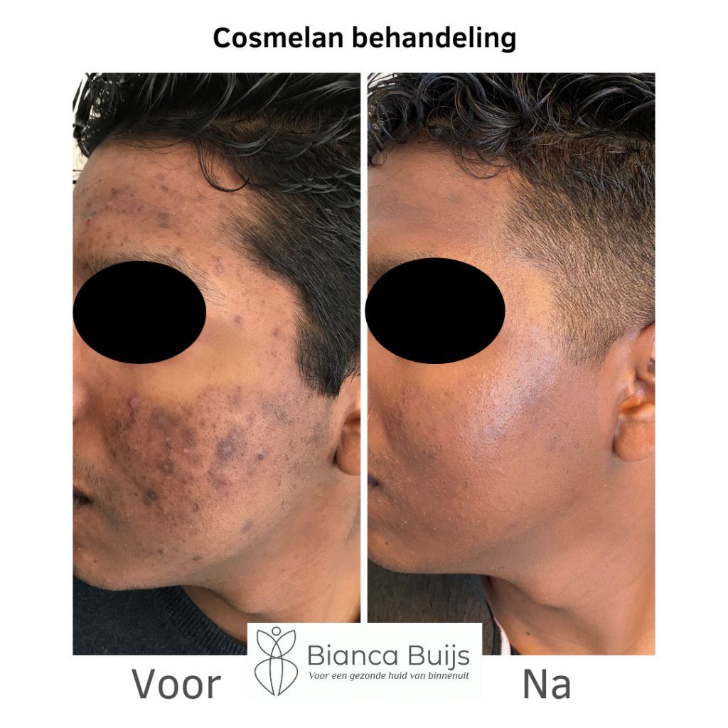 Cosmelan behandeling donkere huid voor en na foto