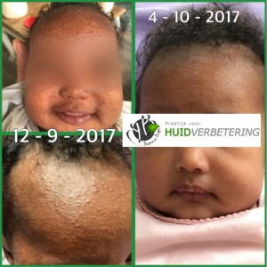 Voor en na foto baby met eczeem en baby acne
