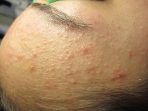 puistjes en acne voorkomen en verminderen