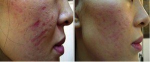 dermapen micro needling behandeling acne littekens voor en na foto
