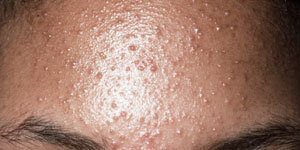 Gistpuistjes of Folliculitis is geen acne