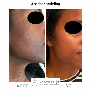 Acnebehandeling donkere huid voor en na foto