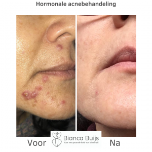 Behandeling hormonale acne voor en na foto