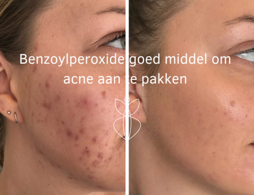 Benzoylperoxide goed middel om acne aan te pakken
