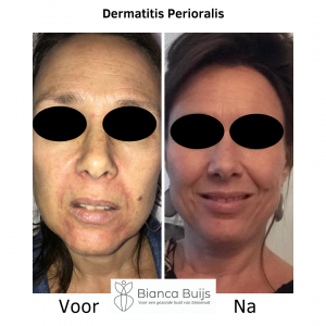 Dermatitis Perioralis, clownseczeem voor en na foto door gebruik van juiste natuurlijke producten