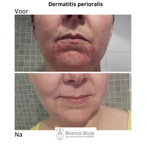 Dermatitis Perioralis voor en na foto