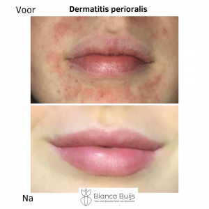 Dermatitis perioralis, clownseczeem voor en na foto
