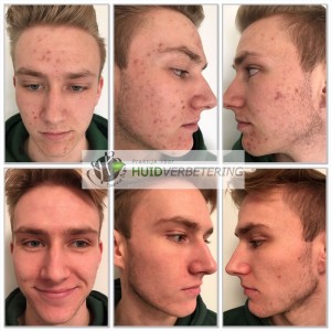 Acne behandeling voor en na foto