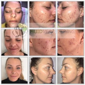Voor en na foto acne behandeling