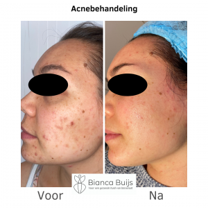 acne littekens verwijderen microneedling voor en na foto
