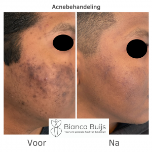 succesvolle acne behandeling donkere huid voor en na foto